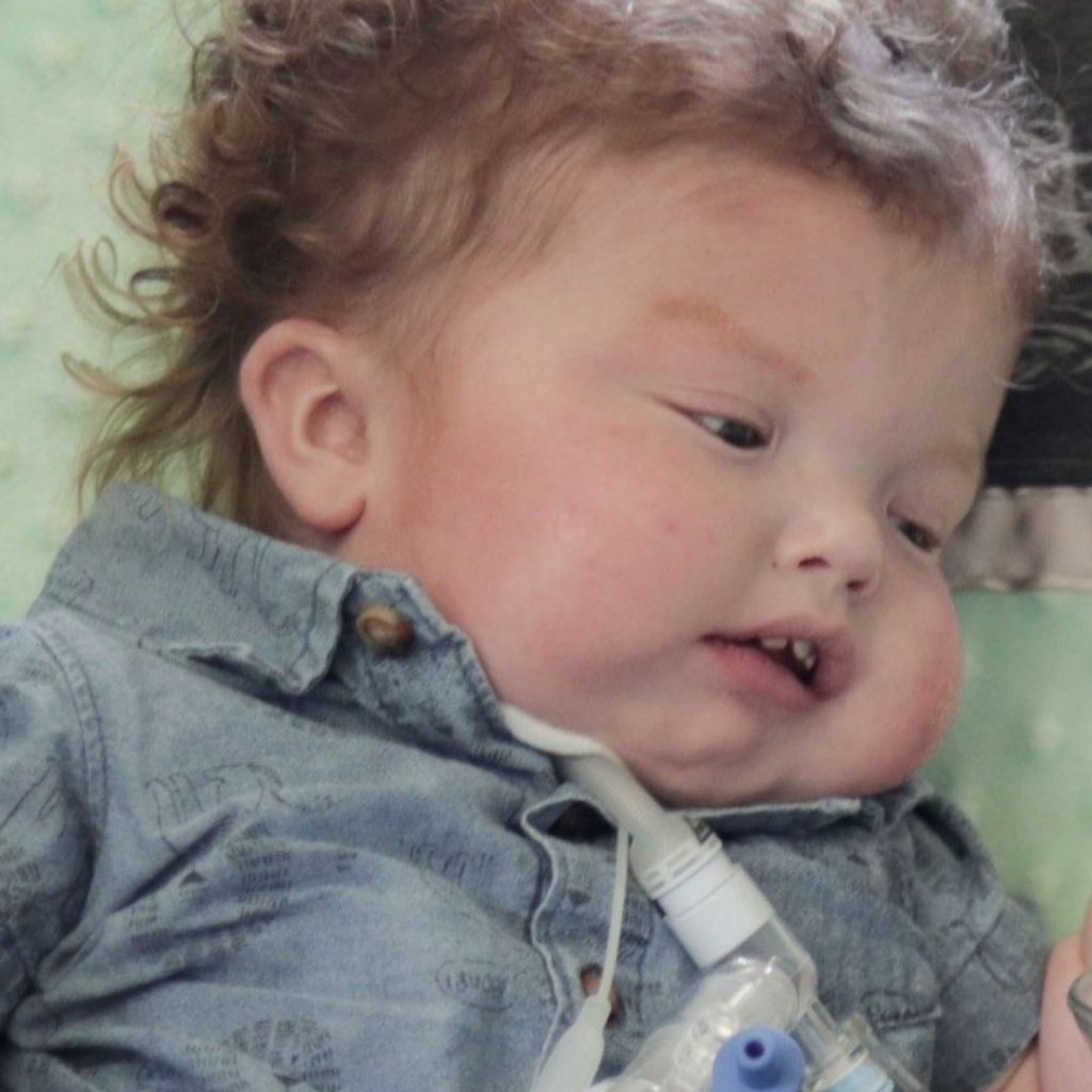 Face of baby boy with a trach